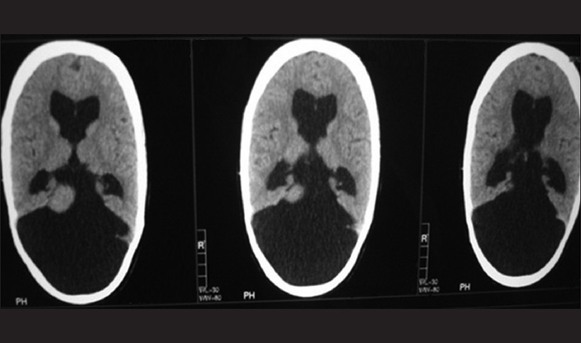 Figure 4: Computed tomography brain shows dandy walker malformation with vermian hypoplasia. Partial agenesis of corpus callosum and colpocephaly with obstructive hydrocephalus