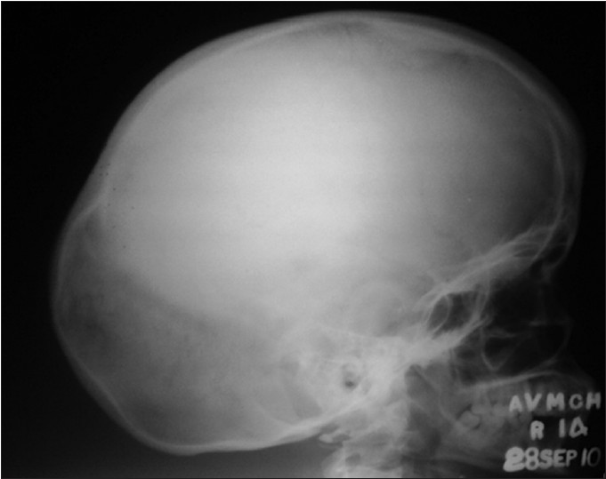 Figure 5: X - ray skull showing macrocephaly