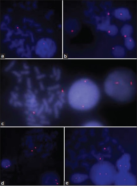 Figure 1: Primed in situ labeling/synthesis images on metaphase as well as interphase cells with Chromosome X (a), Y (b), 13 (c), 18 (d), and 21 (e) specific primers