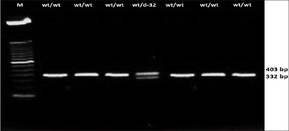Figure 1: CC - chemokine receptor - 5 genotyping among the tribes Lane 1, 2, 3, 5, 6 and 7 represent the PCR product from samples with homozygous wild type genotypes (fragments of 332 bp wt/wt). Lane 4 represents the Δ- 32 genotype (with the presence of both fragment of 332 and 403 wt/Δ32)