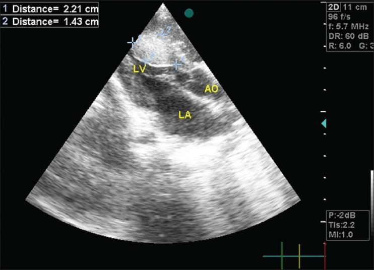 Figure 2: Echocardiography showing rhabdomyoma in left ventricular cavity 21 mm × 15 mm size