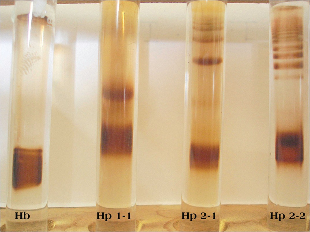 Figure 1: Characteristic pattern of bands of three haptoglobin phenotypes after polyacrylamide gel electrophoresis. Bands correspond to Hp-hemoglobin complexes. The most distal band in each tube represents unbound Hb. Hp phenotypes: First tube Hb band, second tube Hp1-1, third tube Hp2-1 and fourth tube Hp2-2