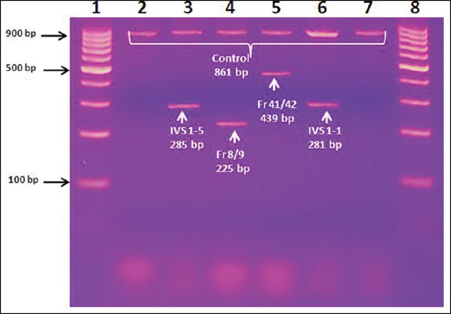 Figure 1: ARMS - PCR gel for the diagnosis of <i>β</i>-thalassemia. DNAs extracted from the whole blood of thalassemic children were amplified by PCR using different primers and were run in agarose gel electrophoresis. the Ethidium Bromide stained gel was visualized on ultraviolet table; lane - 1: 100 bp DNA marker, lane - 3 IVS 1 - 5 mutation (285 bp) with control DNA (861 bp), lane - 4 Fr 8/9 mutation (225 bp), lane - 5 Fr 41/42 mutation (439 bp) and lane - 6 IVS 1 - 1 mutation (281 bp)
