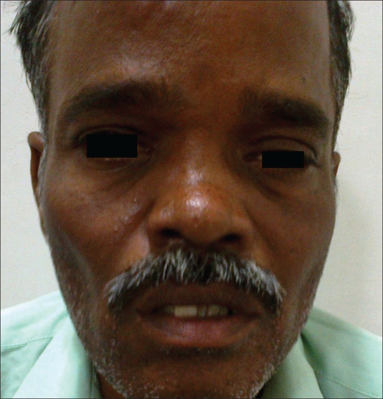 Figure 1: Coarse facial features with left facial palsy