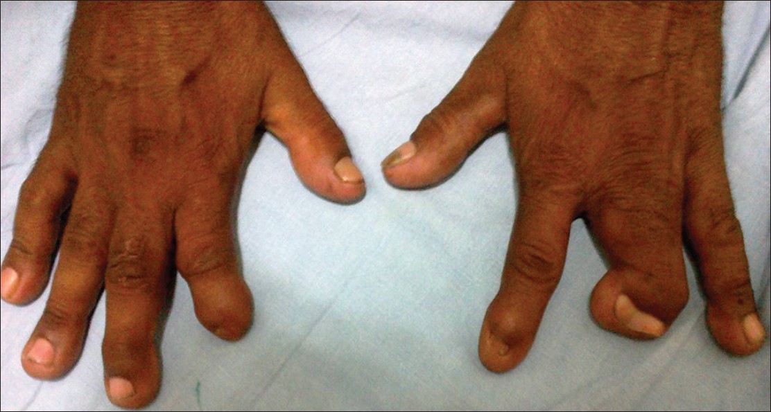 Figure 2: Syndactyly and hypoplastic nails