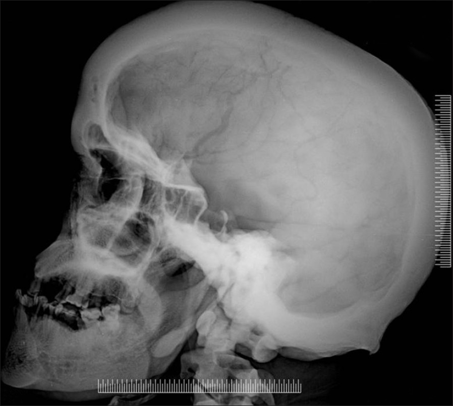 Figure 3: Sclerosed skull bones