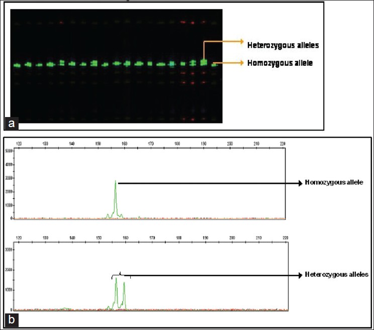 Figure 2: (a) Gel picture showing CAG repeats of POLG gene (b) Gene scan electrophorograms showing CAG repeats of POLG gene
