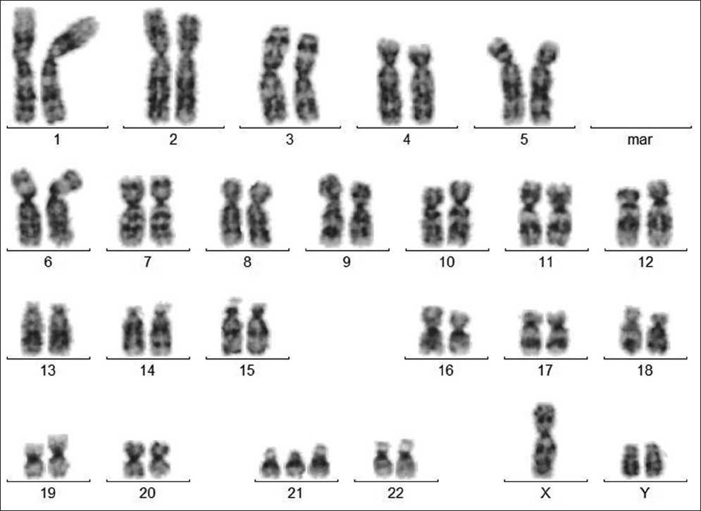 Figure 1: G-banded karyotype showing 48, XYY,+21