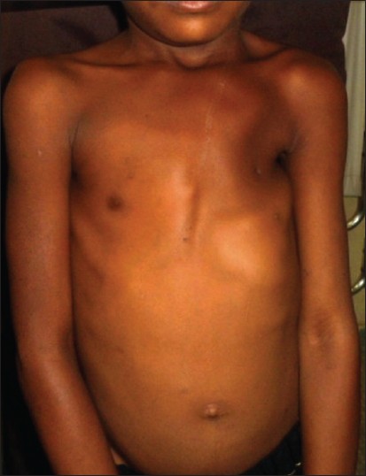 Figure 2: Left anterior chest wall defect with hypoplastic, displaced left nipple
