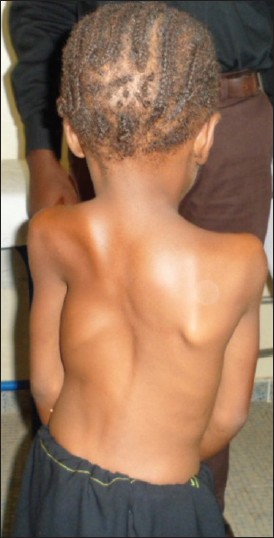 Figure 3: Posterior view of the patient showing hypoplastic displaced left scapula