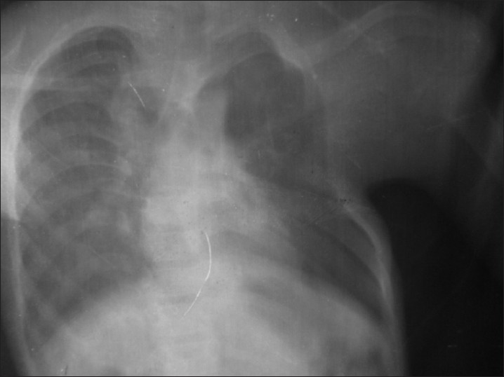 Figure 4: Chest X-ray showing left side anterior chest wall deformity with absent 3<sup>rd</sup>, 4<sup>th</sup> and 5<sup>th</sup> ribs