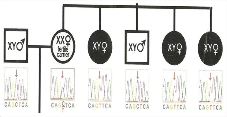 Figure 3: Chromosomal and deoxyribonucleic acid analysis of the parents and maternal aunts. 3 affected maternal aunts showing 46 XY karyotype with C 2754 to T transition of exon 6. Mother is showing similar mutation with 46 XX karyotype, a fertile carrier