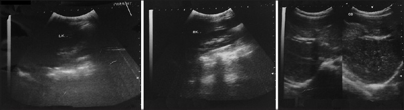 Figure 2: Ultrasonographic images of patients' abdomen. Uterus is not visible