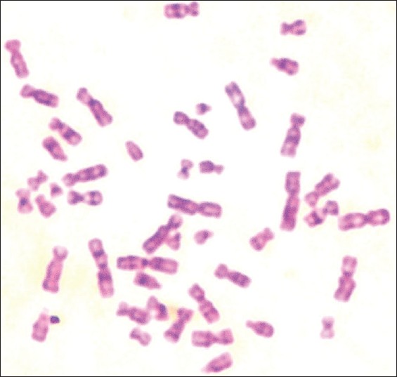 Figure 3: Proband stained and labeled metaphase spread of the patient