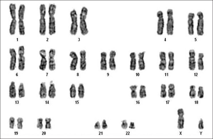 Figure 4: Karyogram of the patient showing 46, XY genotype