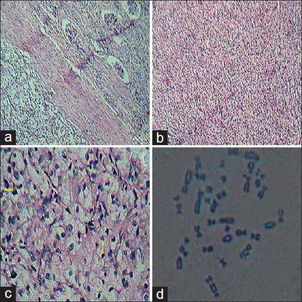 Figure 2: Immunohistochemistry of clear cell renal carcinoma. (a) Low power (×10) view of clear cell renal carcinoma with few glomeruli adjacent to the lesion. (b) Low power (×10) view of clear cell renal carcinoma. (c) High power (×40) of clear cell renal carcinoma comprised of round oval to polygonal cells with mildly pleomorphic vesicular nuclei, inconspicuous nucleoli and clear cytoplasm. Increased mitosis (shown in yellow arrow) was observed. (d) Karyotyping analysis of Von Hippel-Lindau gene mutation with clear cell renal carcinoma