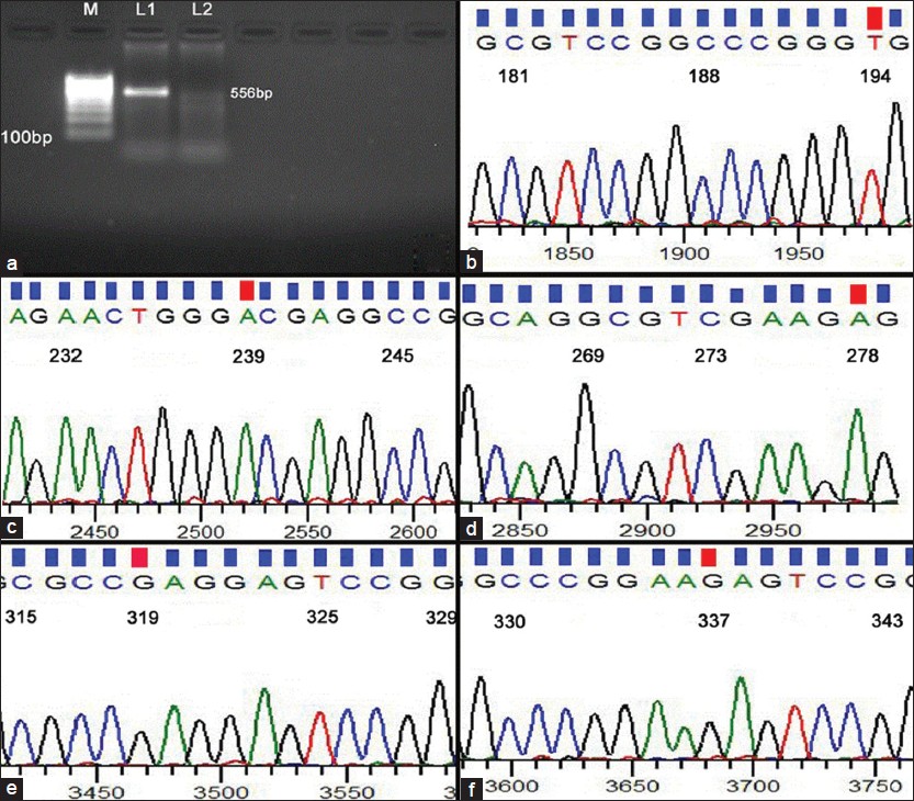 Figure 3: (a) Polymerase chain reaction (PCR) amplification of exon 1 of Von Hippel-Lindau (VHL) gene using VHL Forward primer (FP) and VHL Reverse primer (RP) primers following the method described, Lane M molecular size marker obtained from Bangalore Genei Pvt. Ltd., lane L1 PCR amplified product. (b-d) The chromatogram showing mutations in p.Ala 65 Val, p.Gly 80 Asp, p.Gly 93 Glu, p.Gln 107 Glu, p.Gln 113 Glu in exon 1 of VHL gene leading to missense mutations