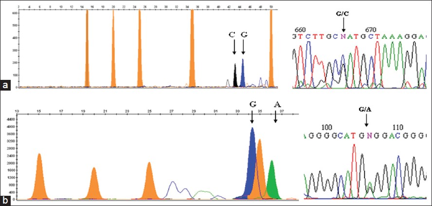 Figure 1: Genotypes have been shown by SNaPshot assay. The genotypes are analysed based on the color of the peak and fragment length. The orange peaks indicate size standard LIZ120GS. (a) Interleukin - 6 - 174G>C genotyping by SNaPshot indicates both G and C allele. The corroborating sequencing electropherogram is adjacent. (b) Tumor necrosis factor alpha - 308G>A genotyping indicates both G and A allele. The sequencing electropherogram of the same is adjacent
