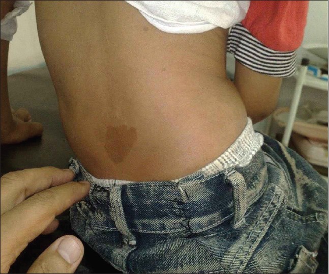 Figure 1: Café-au-lait spots on the back of the reported child