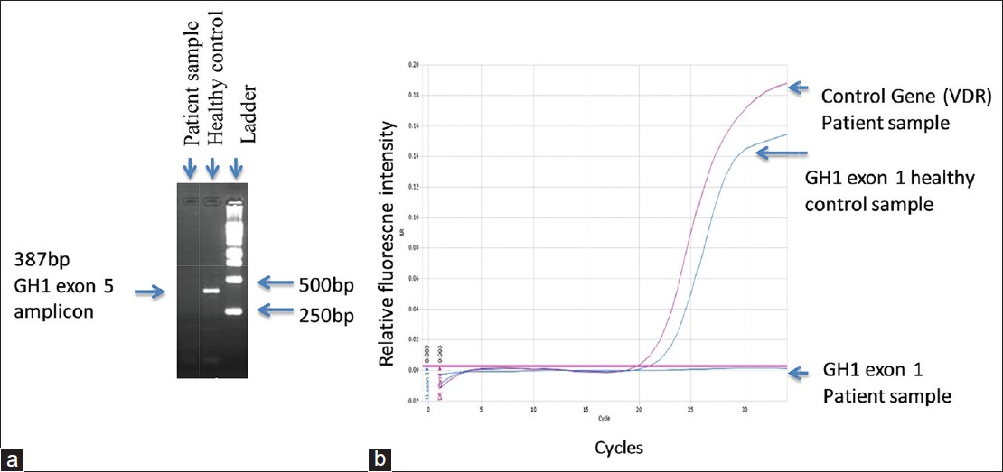 Figure 1: (a) Gel electrophoretic analysis of polymerase chain reaction (PCR) products of growth hormone (GH) 1 exon 5: Expected amplification is seen in healthy control. There was no amplification in the proband. (b) Real-time SYBR Green PCR of GH1 exon 1. Healthy control showed expected amplification. No amplification was seen in the proband's sample. Amplification of the <i>VDR</i> gene used as the control gene in the patient's sample showed normal amplification