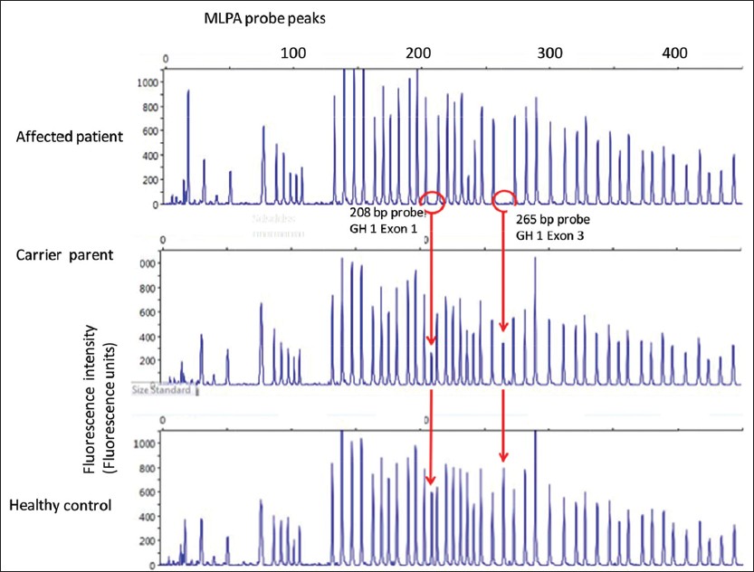Figure 2: Multiplex ligation-dependent probe amplification (MLPA) analysis of proband sample along with father's sample (maternal data not shown). The GH1 specific amplicons (208 base pairs (bp) and 265 bp) are absent in the proband samples, at reduced intensity (nearly half normal indicating a heterozygous state) in the parental sample, and at full intensity in the control sample from a healthy male. (MLPA analysis of fetus not demonstrated graphically)