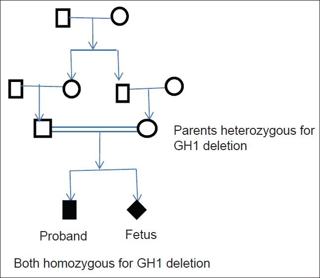 Figure 3: Family tree both parents are heterozyogus carriers of the GH 1 deletion. The proband and unborn fetus are homozygous for the same deletion