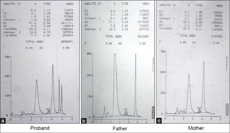 Figure 1: Cation exchange high performance liquid chromatography of case 1 (proband and parents). The patient's sample (a) demonstrates four prominent peaks: Hemoglobin (Hb) A, HbD Punjab, HbQ India, and the hybrid HbQ India/HbD Punjab eluting in HbC window (retention time 4.96 - 4.97 min). The parent's samples (b and c) demonstrate two prominent peaks of HbA and HbQ India and HbA and HbD Punjab, respectively