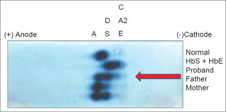 Figure 2: Agarose gel electrophoresis at alkaline pH showed bands in the A, S, and C positions. This was interpreted as HbA in the A position, HbD Punjab in the S position, and HbD Punjab/HbQ India in the C position