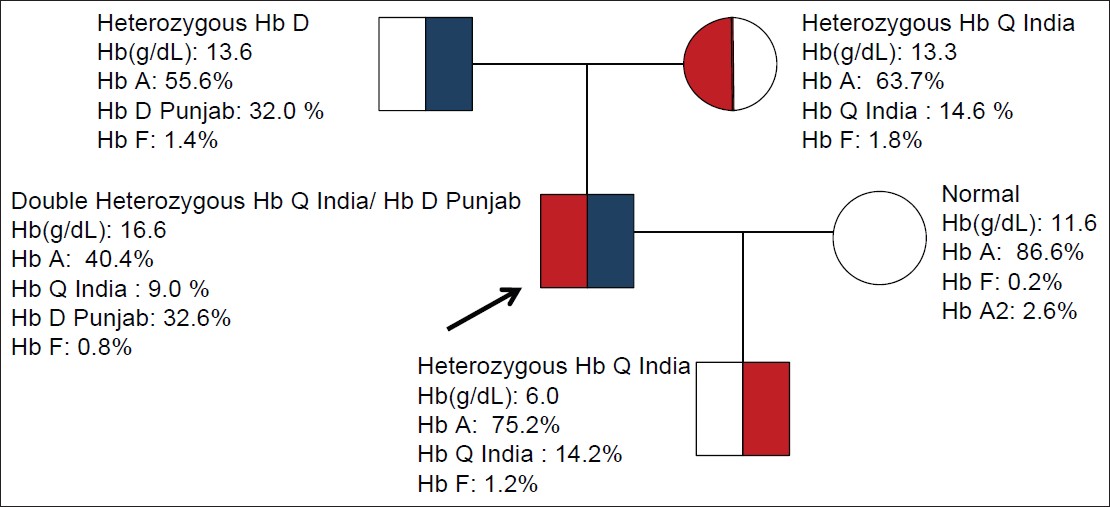 Figure 3: Pedigree of family with HbQ India/HbD Punjab double heterozygosity. The arrow indicates the case. The father was heterozygote for HbD Punjab and mother was HbQ India heterozygote. His son has inherited only the heterozygous HbQ India and his wife is normal
