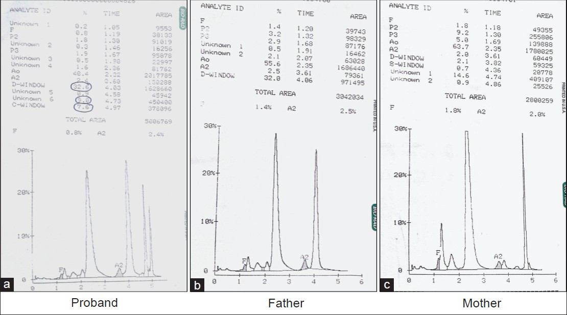 Figure 4: CE HPLC of case 2 (proband and parents). The patient's sample (a) demonstrates four prominent peaks: HbA, HbD Punjab, HbQ India, and the hybrid HbQ India/HbD Punjab eluting in Hb C window (retention time 4.96 - 4.97 min). The parents' samples (b and c) demonstrate two prominent peaks of HbA and HbD Punjab and HbA and HbQ India, respectively