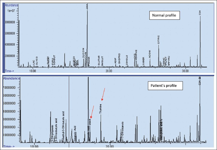 Figure 2: Normal urine organic acid profile and our patient's profile showing two prominent thymine and uracil peaks (red arrows) in the later