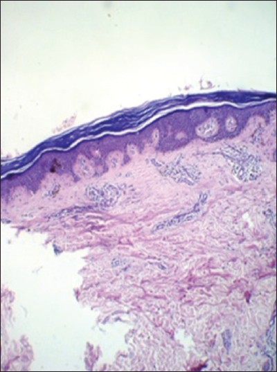 Figure 3: Histopathology of the skin lesion shows epidermis was mildly atrophic with hyperkeratosis. Basal layers showed mild vacuolar change, papillary dermis with melanin incontinence, and dilated dermal vessels (hematoxylin and eosin (H and E, ×10)