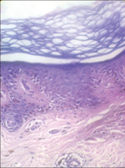 Figure 4: Histopathology of the skin lesion: In high power, section shows increase in pigment extending into the stratum spinosum. Dermis showed mild perivascular and periadnexeal lymphomononuclear infitrate (H and E, × 10)