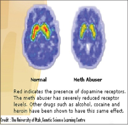 Figure 1: Diagram depicting the difference in the quantities of dopamine receptors in the brain of a methamphetamine addict (right) and non-addict (left)