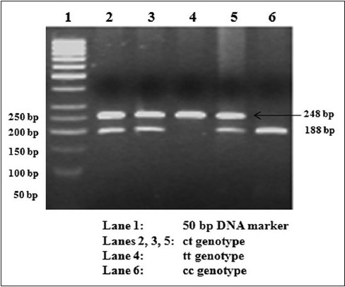 Figure 1: Restriction fragment length polymorphism (RFLP) gel photograph of rs1799854 (-3c → t) polymorphism in ABCC8 gene