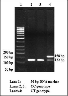 Figure 2: RFLP gel photograph of rs1801261 (Thr759Thr, C → T) polymorphism in ABCC8 gene