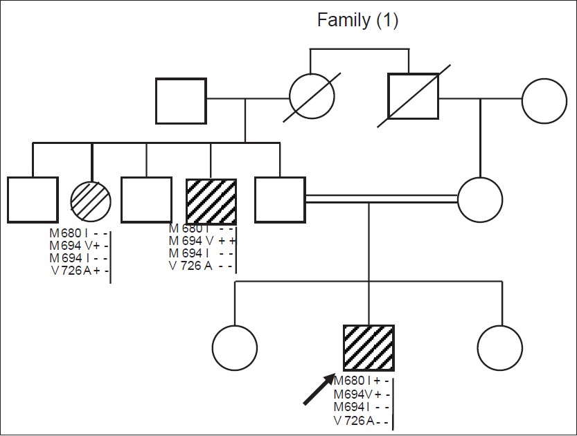Figure 1: Pedigree of a multiplex familial Mediterranean fever (FMF) family (three cases), proband is a male 12 years old genotyped M694V/M680I, started to complain at the age of 9.5 years. There is positive consanguinity. His uncle is genotyped homozygous M694V; his aunt is genotyped M694V/V726A. So, allele M694V is common in all affected members. Empty squares and circles are no-tested, filled squares and circles are symptomatic FMF cases