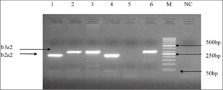 Figure 2: Agarose gel showing two types of characteristics breakpoint cluster region-abelson transcripts b2a2 (lanes 1, 4) and b3a2 (lanes 2, 3, 6), 234 bp and 305 bp respectively (M: 50 bp deoxyribonucleic acid ladder, NC: Negative control)