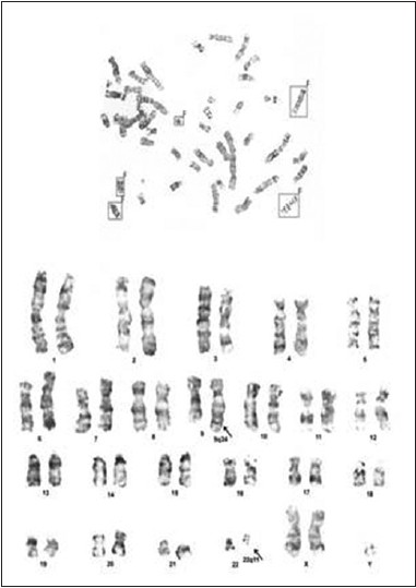 Figure 1: Cytogenetic study shows 47, XXY karyotype with Philadelphia chromosome abnormality