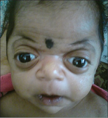 Figure 1: Raine syndrome baby showing exophthalmos, small nose with depressed nasal bridge, long philtrum and dysplastic ears