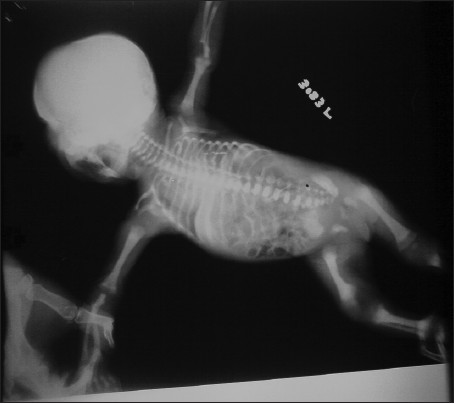 Figure 2: Infantogram of baby showing generalized osteosclerosis of bones