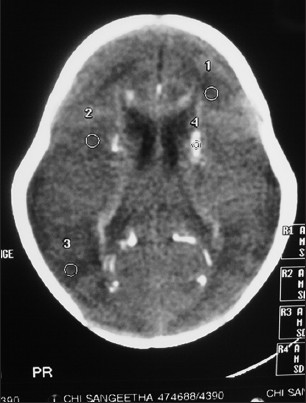 Figure 3: Computed tomography scan of the brain showing calcifications in periventricular white matter, corpus callosum and basal ganglia