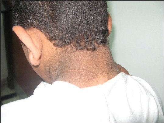 Figure 5: Acanthosis nigricans of the neck