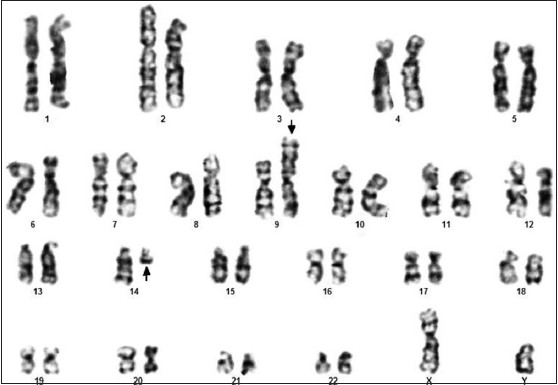 Figure 1: G-banded karyotype of the bone marrow cells showing t(9;14)(p24;q13)