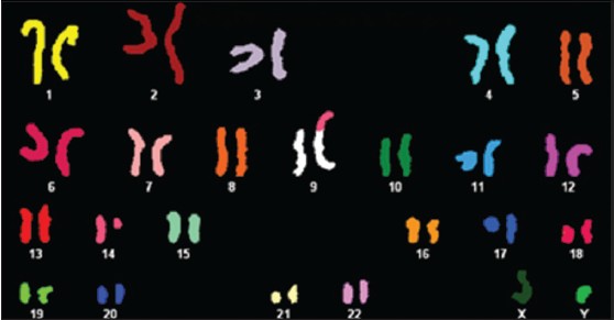 Figure 2: Spectral karyotyping of the metaphase spread after spectrum based classification. The karyotype was confirmed as der (9)t(9p;14q)