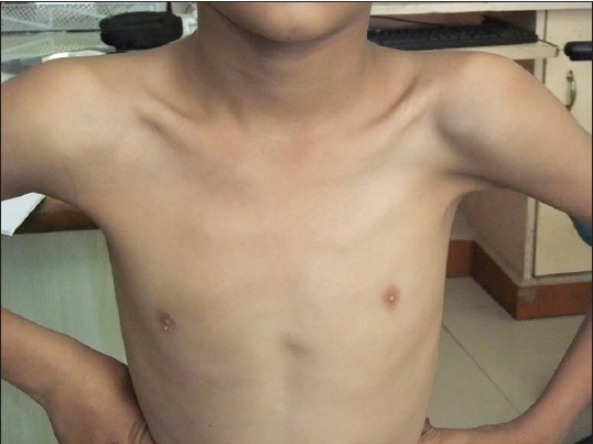 Figure 1: Pectoral muscles are absent on the left side