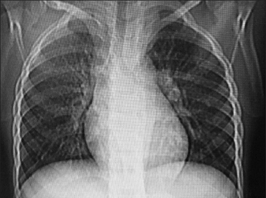 Figure 3: Plain chest radiography shows increased lucency over the left side due to the absence of chest muscle