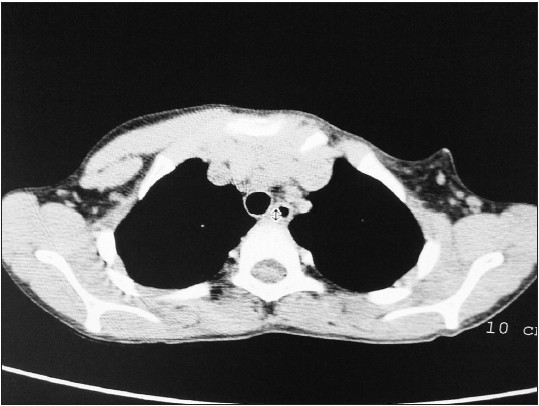 Figure 4: Axial plain computed tomography scan shows absent pectoralis major on the left side