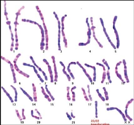 Figure 1: Karyotype of the daughter(S) showing the balanced homologous chromosomal translocation t (22q;22q)
