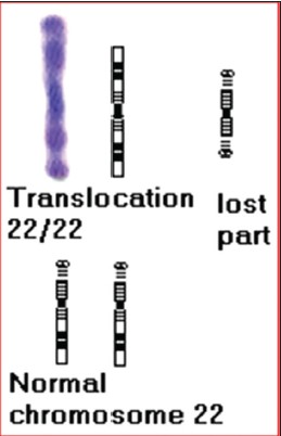 Figure 3: Partial Karyotype and the ideogram of the daughter (S)
